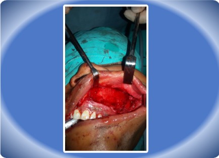 JAW TUMOUR